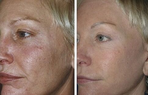 フラクショナルレーザーによる若返りの前後の写真
