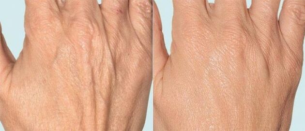 フラクショナルセラピー前後の手の皮膚